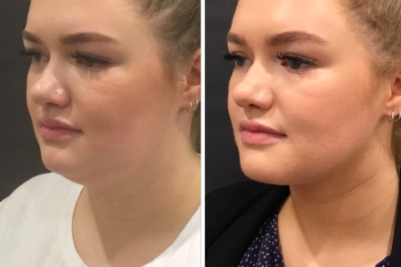 CoolSculpting Chin