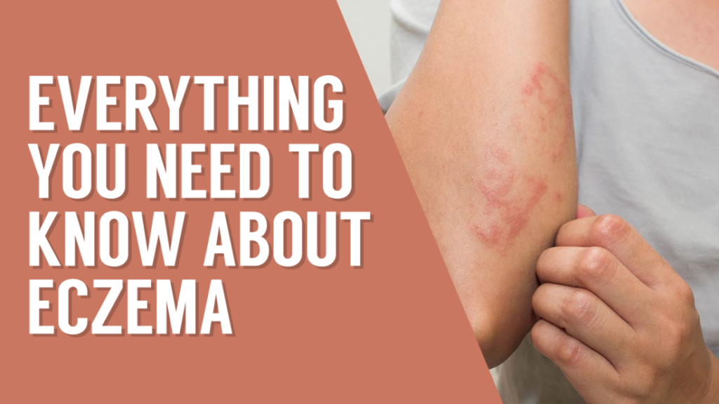 Everything you need to know about eczema – Health Blog