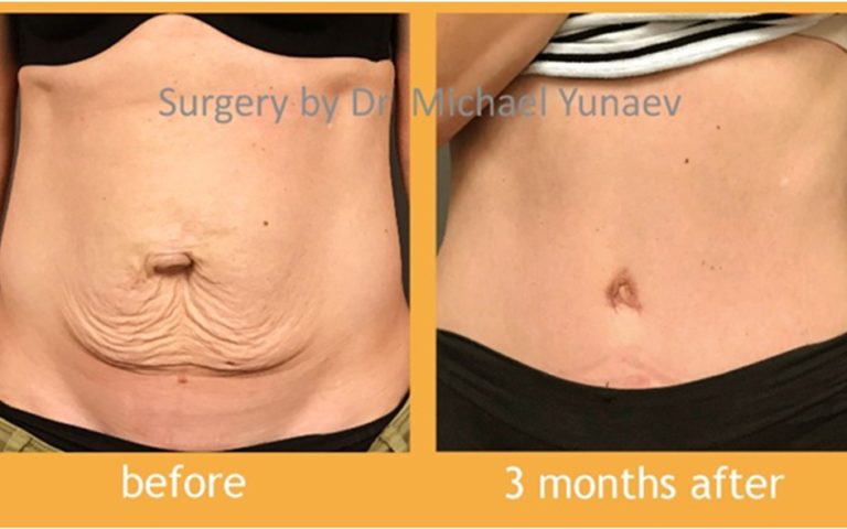 Tummy Tuck And Breast Augmentation Procedure