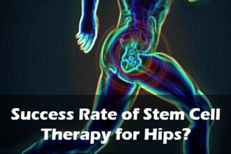 Success Rate of Stem Cell Therapy for Hips