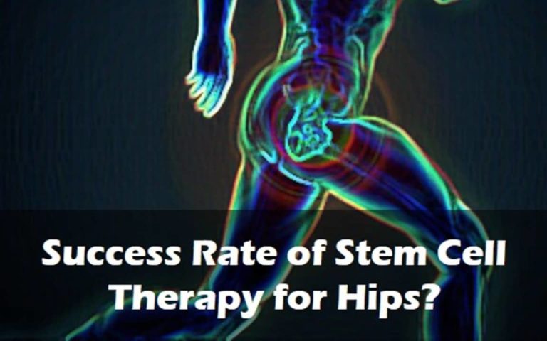 Success Rate of Stem Cell Therapy for Hips