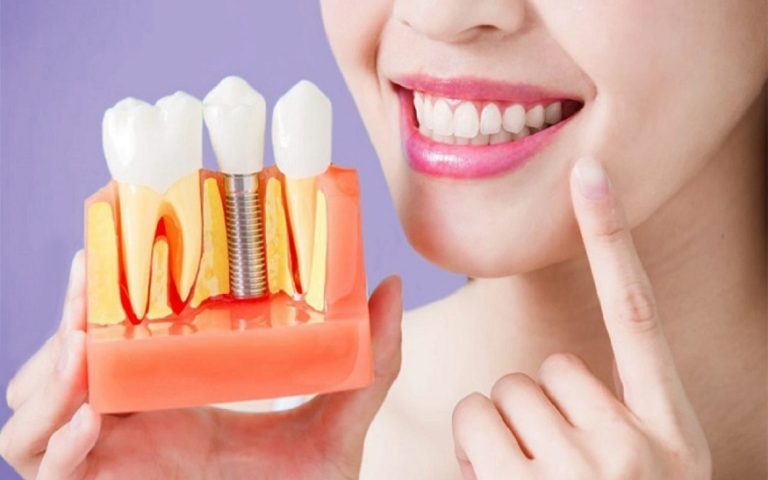 Why You Should Get Dental Implants