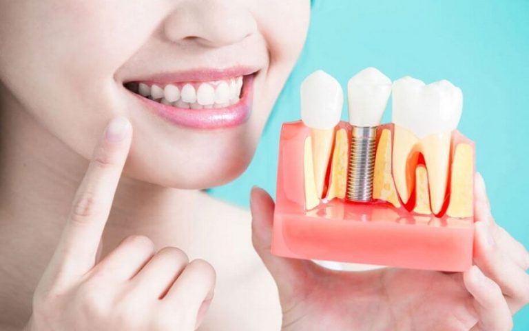 Are Dental Implants Right for Your Smile