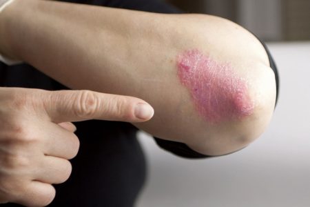 LIFESTYLE PRACTICES YOU CAN ADOPT TO MANAGE PSORIASIS SKIN CONDITION