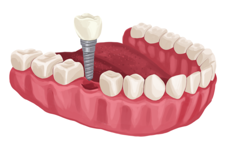 Can a Dentist Tell if You Have Diabetes