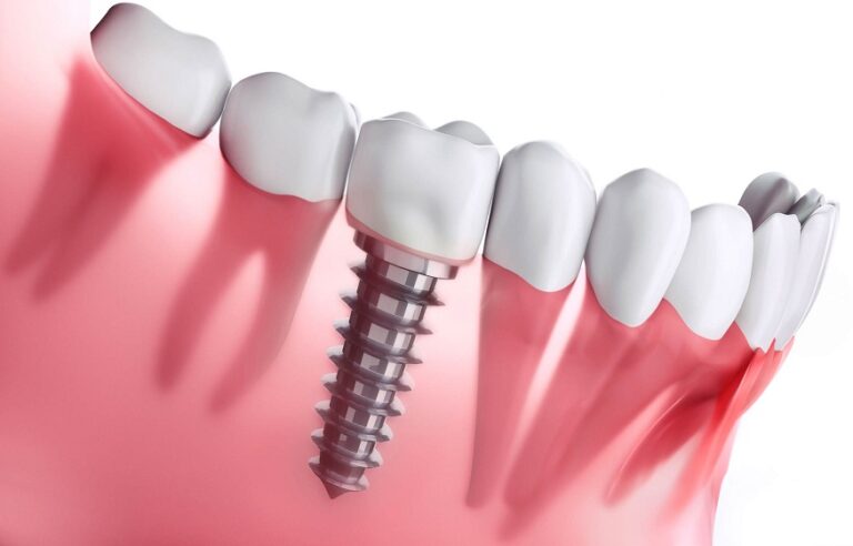 Are Dental Implants the Right Option for Severe Bone Loss | Dinedsrg.com