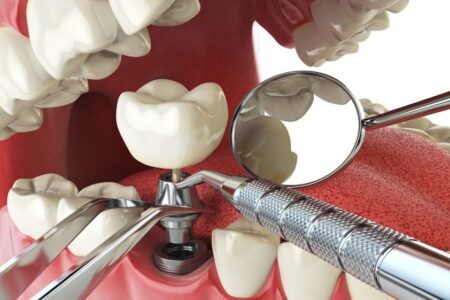 Demystifying Dental Implants