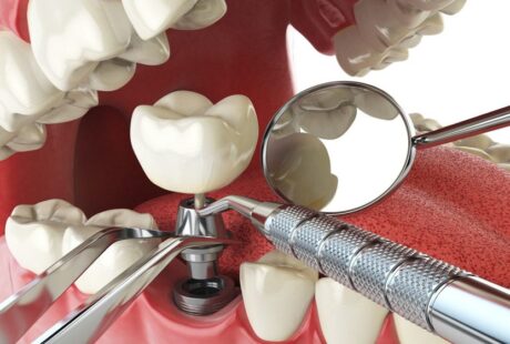 Demystifying Dental Implants