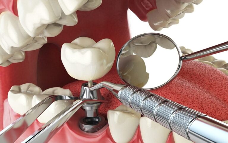 Demystifying Dental Implants