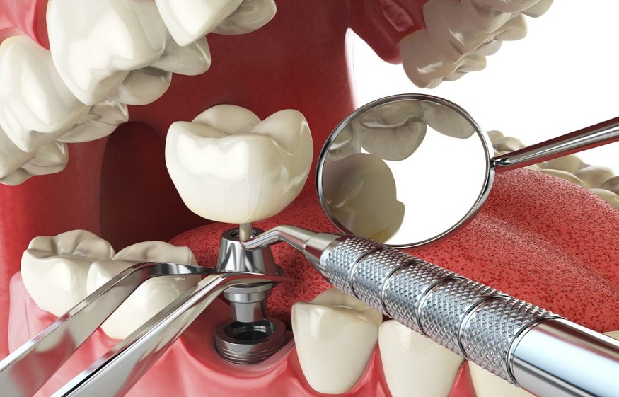 Demystifying Dental Implants