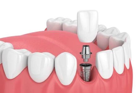 Dental Implant Journey