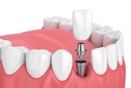 Dental Implant Journey