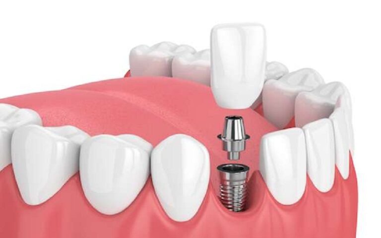 Dental Implant Journey