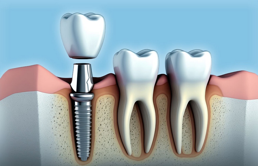 Dental Implants