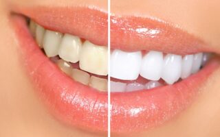 Teeth whitening benefits