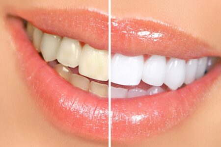 Teeth whitening benefits