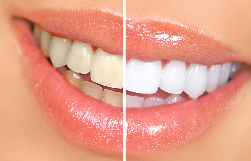 Teeth whitening benefits