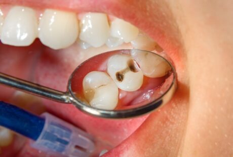 Tooth Decay